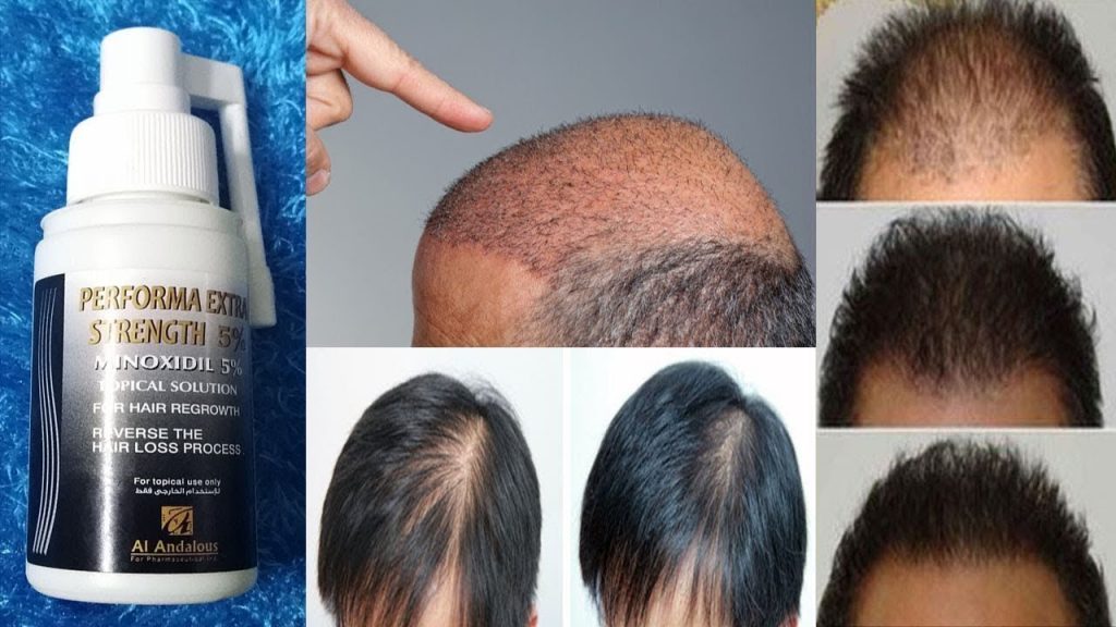 بخاخ مينوكسيديل Minoxidil